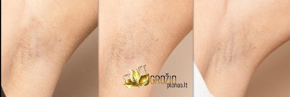 IPL fotoepiliatorius plauku salinimas fotoepiliatoriumi - grozioplanas.lt