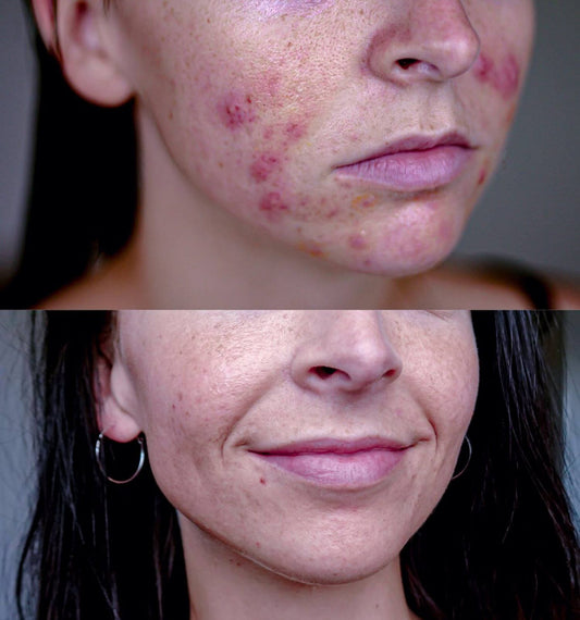 Science of Skin | Spuogu ir spuogu randu gydimo priemonė - grožio-planas.lt